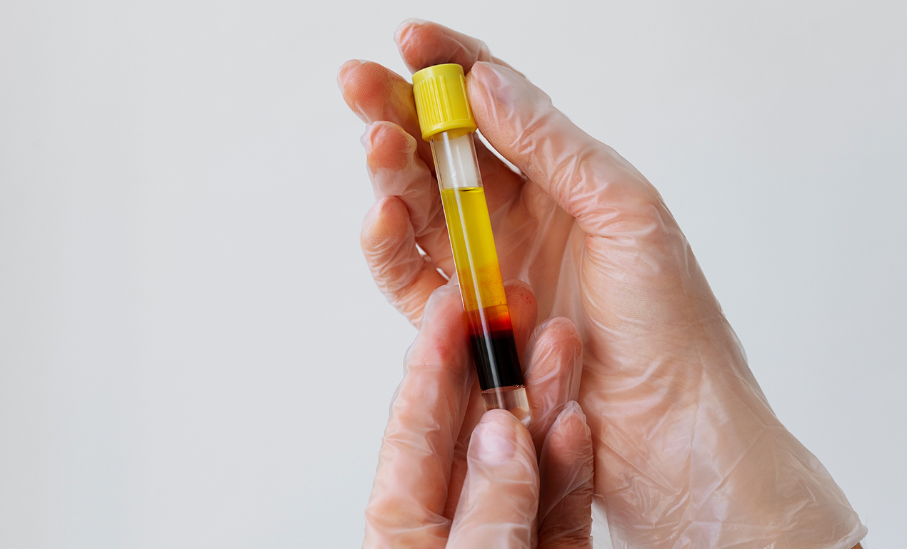 VİTAMİN D3 ( 25-OH)