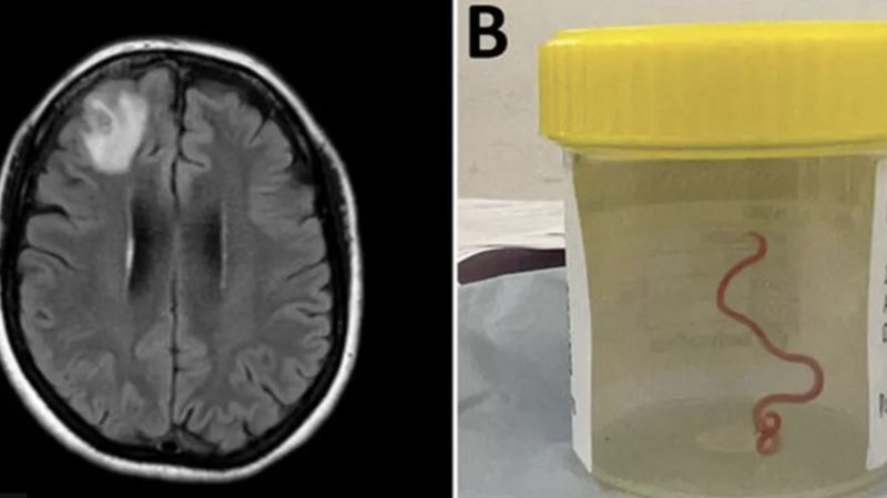 Tıp Literatüründe İlk: Avustralya'da Bir Kadının Beyninden Canlı Solucan Çıkarıldı